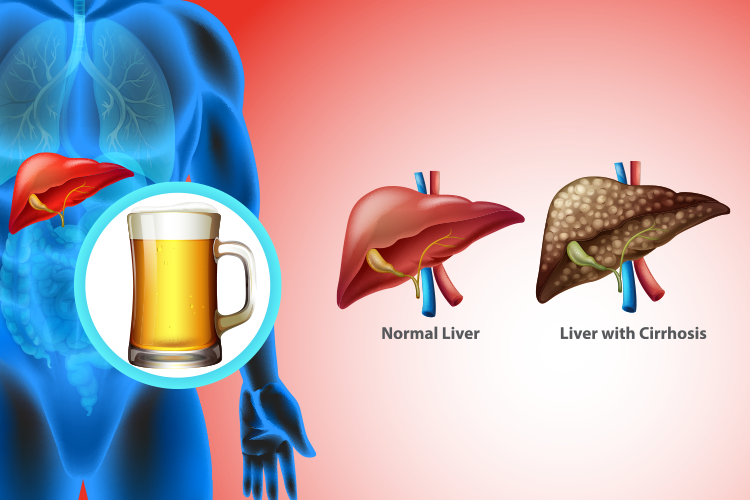 How Alcohol Affects Your Liver Health