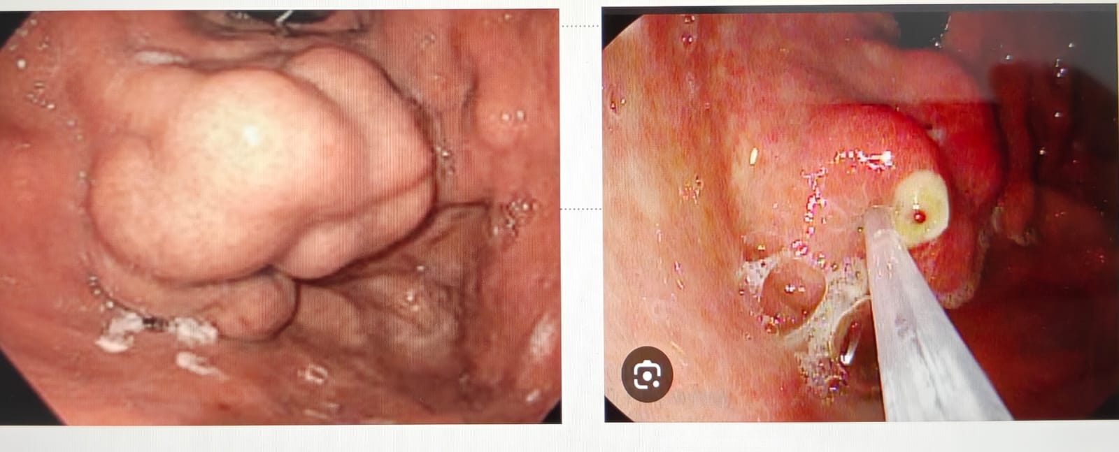 Endoscopy Doctor in Noida Sector 128