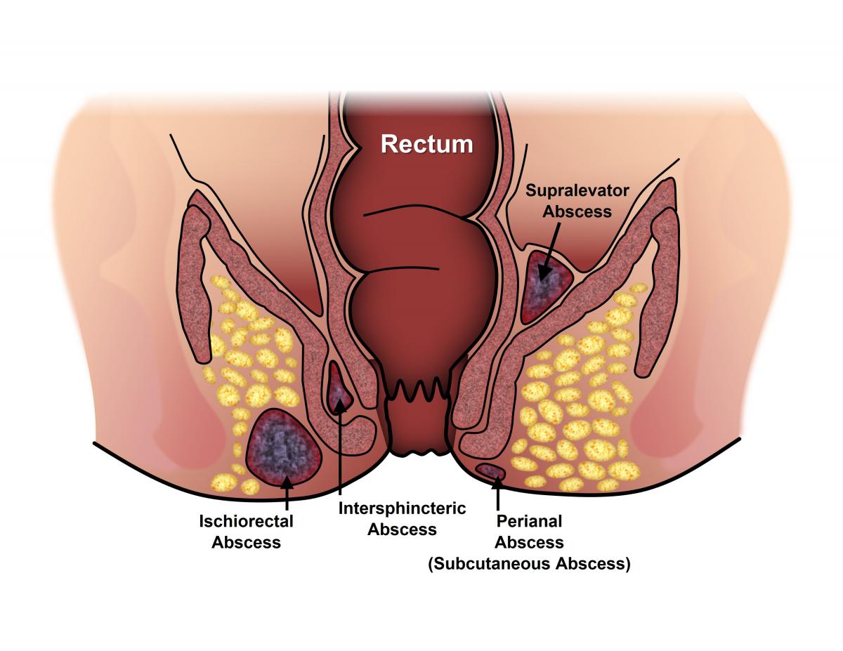 Anorectal Dyssynergia Treatment in Noida