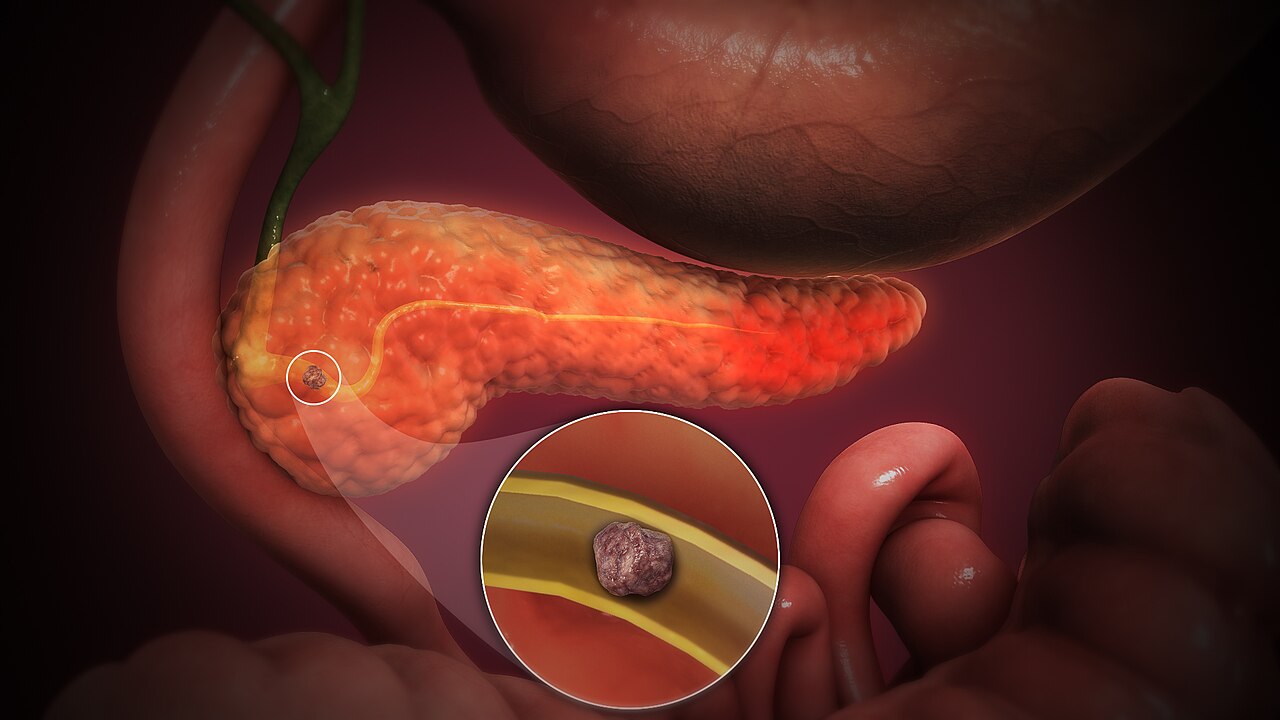 Pancreas Disease Treatment in Noida Sector 128