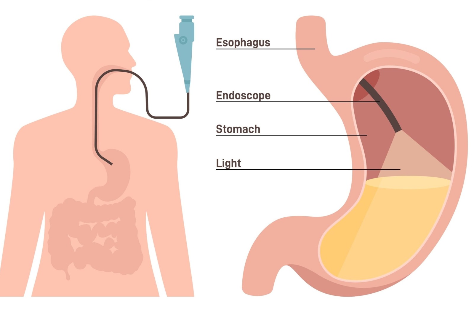Upper Gastrointestinal Endoscopy in Noida